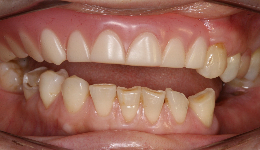 Severe wear of natural lower Teeth and Denture Teeth	